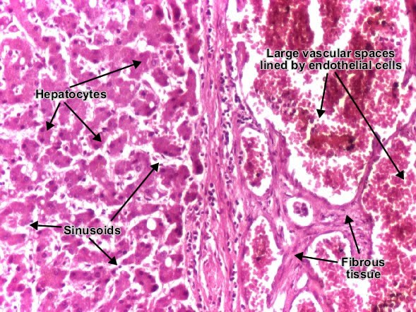 Capillary Hemangioma Histology