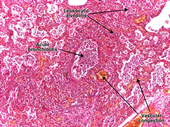 موقع الدكتور أحمد كلحى: صور باثولوجى - Pathology Slides : Pulmonary ...