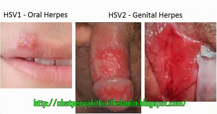 Oral Herpes – Symptoms, Pictures, Causes, Treatment