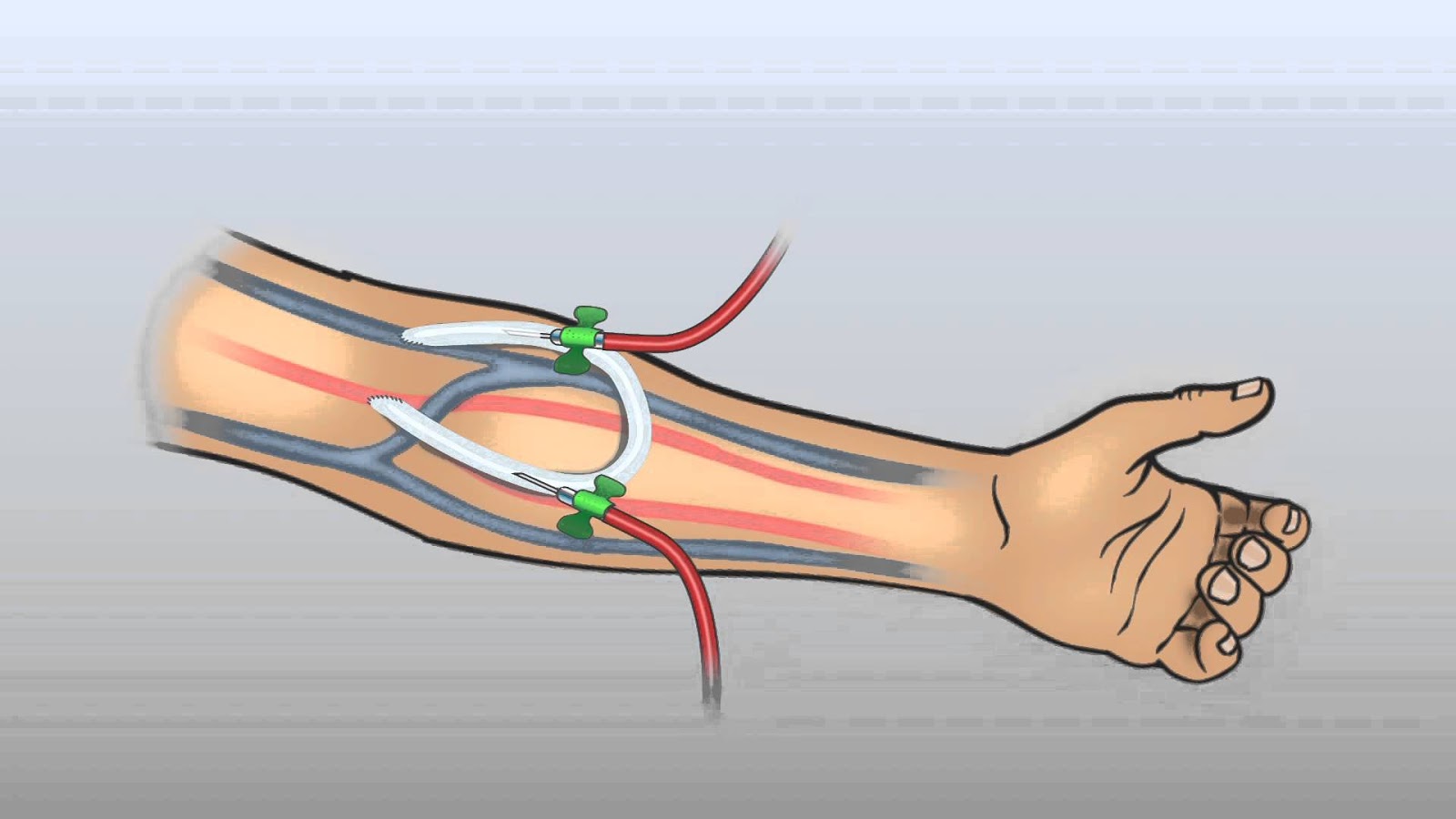 MEDICINE: The arteriovenous (AV) graft part 1