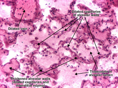 موقع الدكتور أحمد كلحى: صور باثولوجى - Pathology Slides : Pulmonary ...