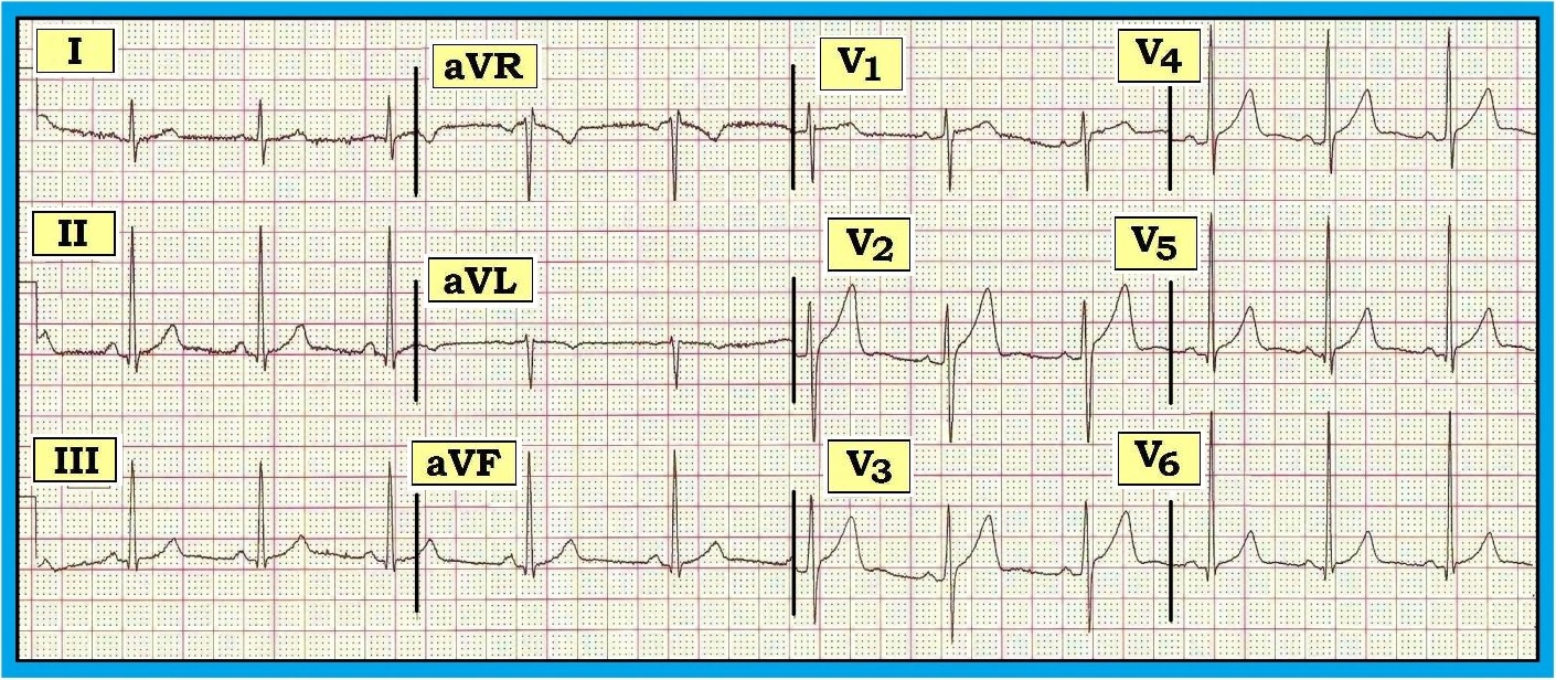 Normal 12 Lead Ecg Labeled