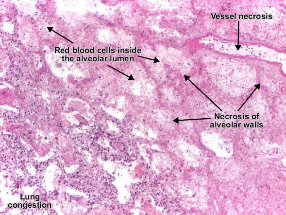 موقع الدكتور أحمد كلحى: صور باثولوجى - Pathology Slides : Pulmonary ...