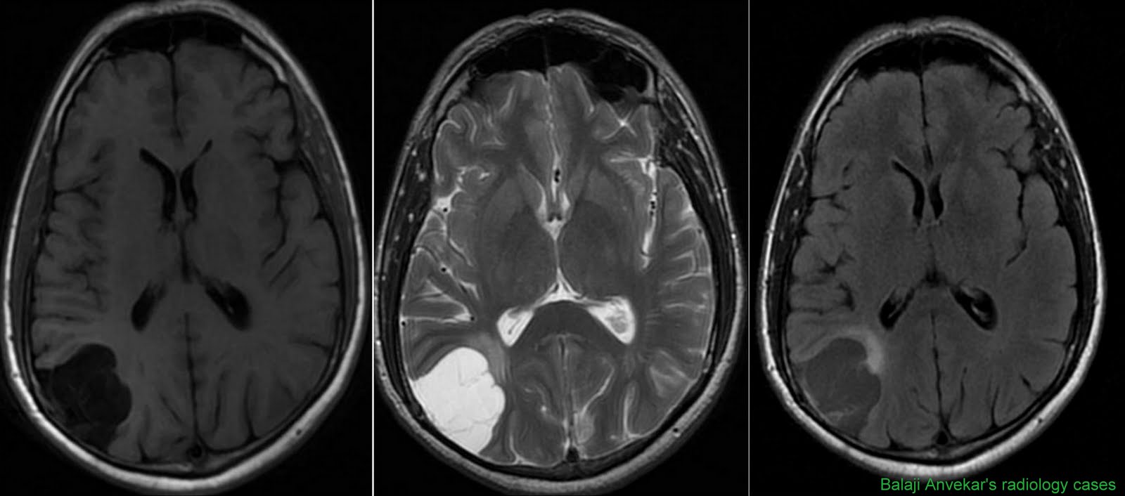 Brain Mri: Vasculitis Brain Mri