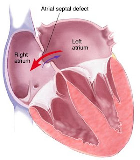 Nursing Care Plans For Atrial Septal Defect