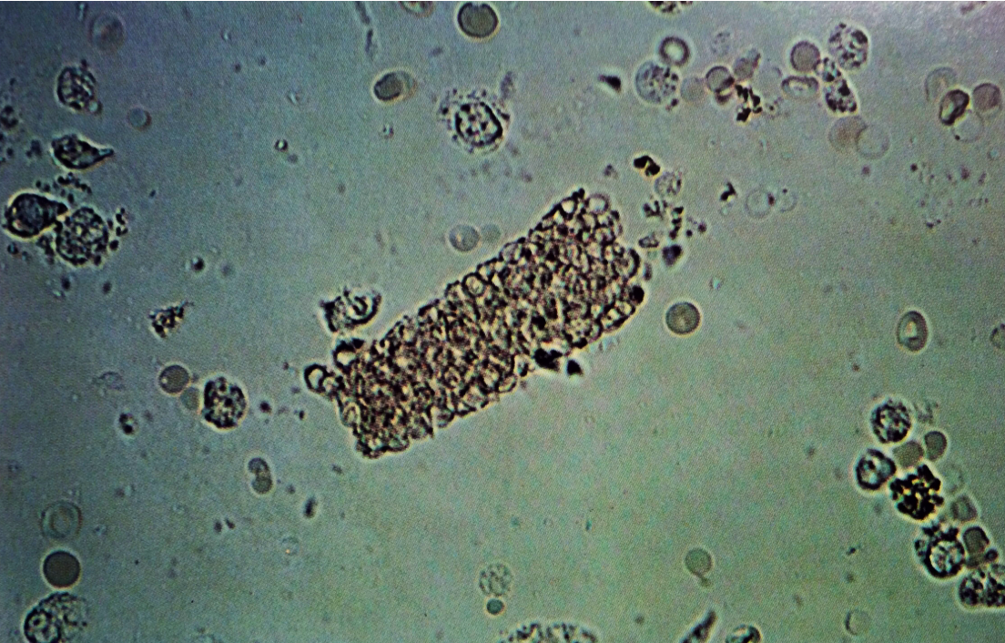 Red blood cell cast, showing predominately intact erythrocytes closely packed together. Surrounding urine is filled with numerous PMNs and erythrocytes
160X
Source: Urinary Sediment: A Textbook Atlas. Haber, Meryl H.