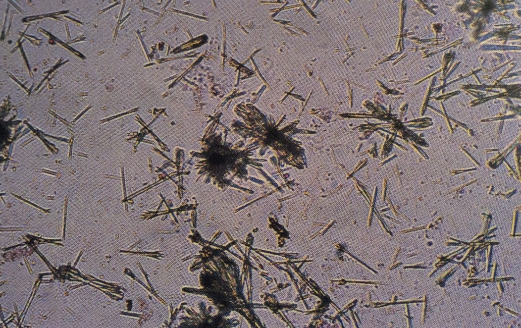 Ampicillin crystals
Bundles of crystals are seen after refrigeration
400X
Source: Urinalysis and Body Fluids: Strasinger, Susan K.