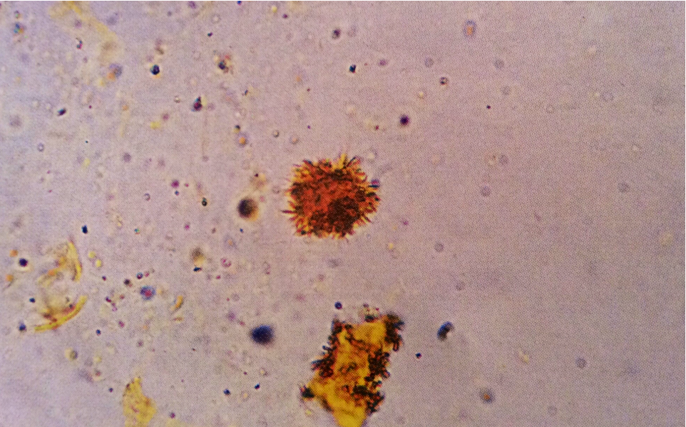 Bilirubin crystals
Notice the classic bright yellow color
400X
Source: Urinalysis and Body Fluids: Strasinger, Susan K.