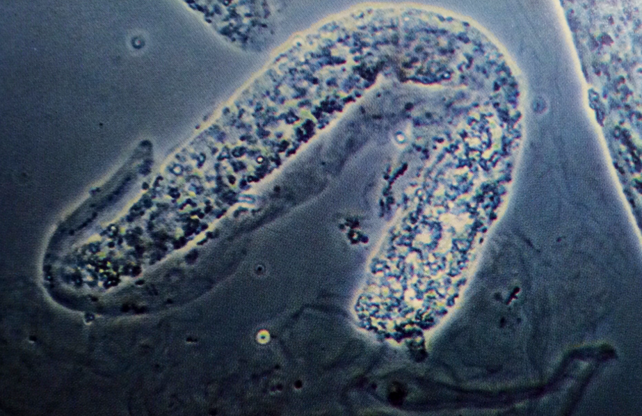 Granular cast with numerous mucus threads in the background
Phase-contrast microscopy, 200X
Source: Urinary Sediment: A Textbook Atlas. Haber, Meryl H.