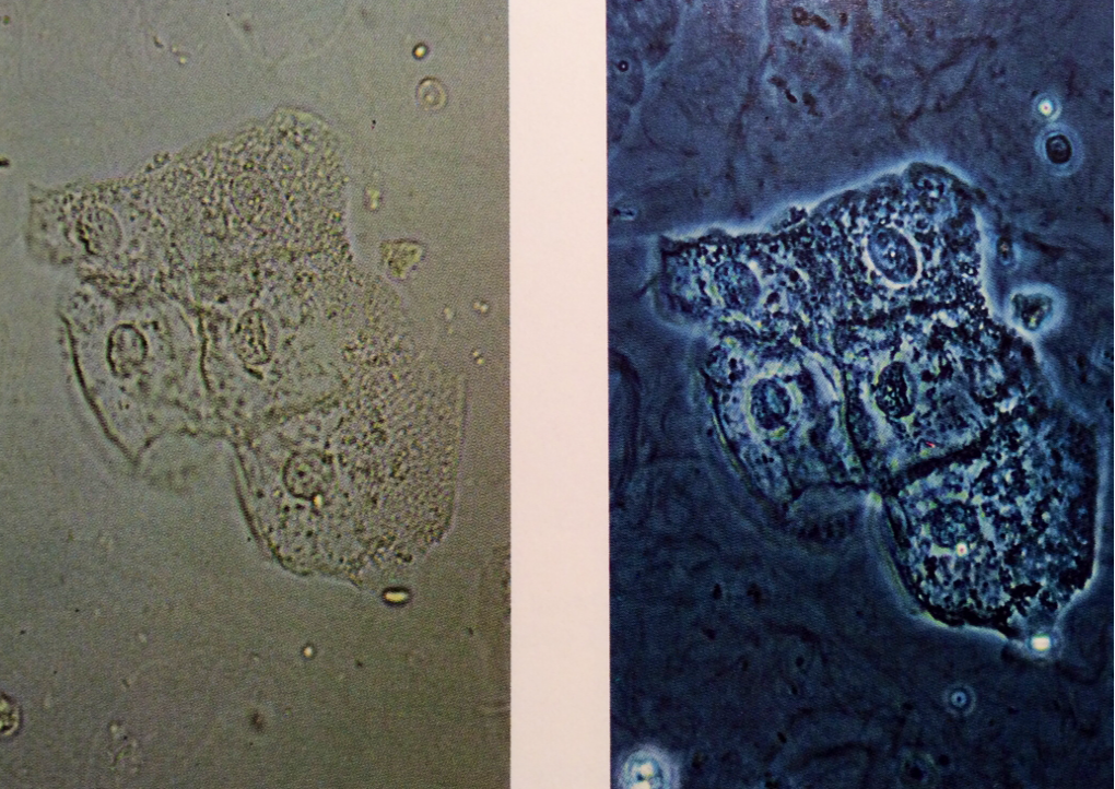 L: Squamous epithelial cells, commonly seen in clumps, but also singly. They are large, flat, and often have finely wrinkled cytoplasm
200X
R: Group of squamous epithelial cells with mucus strands in the background. Here, the difference between...