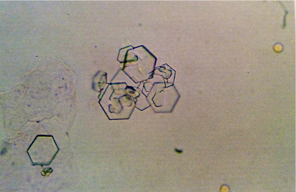 Cystine crystals
Notice the colorless, hexagonal plates. They differ from uric crystals by color and inability to polarize
400X
Source: Urinalysis and Body Fluids: Strasinger, Susan K.