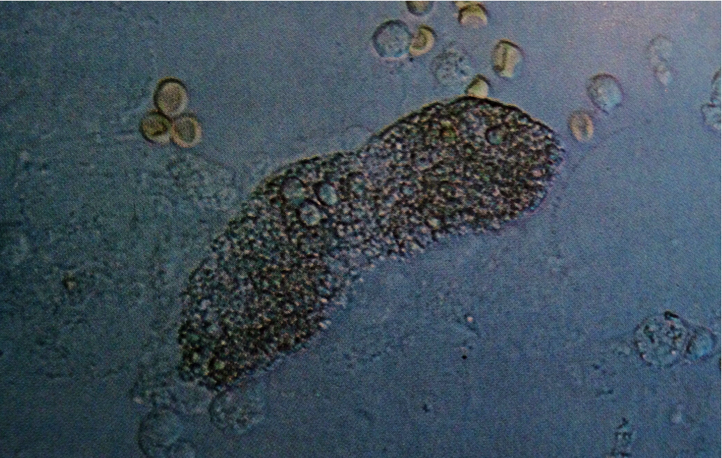 Typical fatty cast in urine. Entire surface seems to comprise lipid globules of variable sizes. In the background, are several red cells and considerable cellular debris
200X
Source: Urinary Sediment: A Textbook Atlas. Haber, Meryl H.