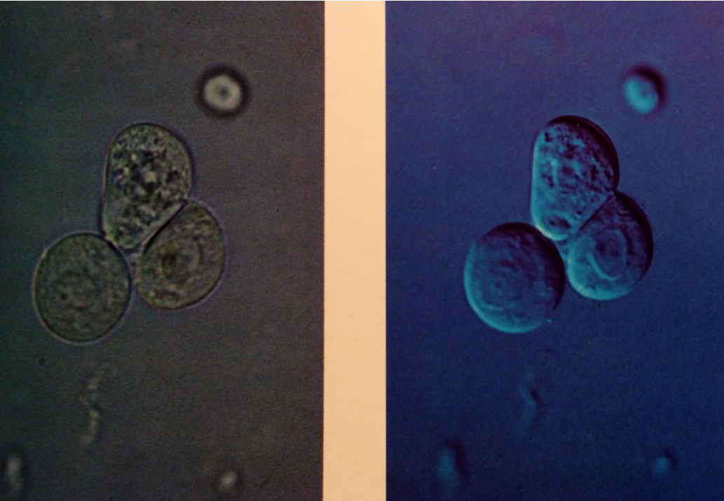 L: Transitional epithelial cells, which are nearly spheric due to absorption of water and have large, central nuclei
320X
R: Transitional epithelial cells in urinary sediment. This relief image clarifies spheric shape of these cells and nuclear...