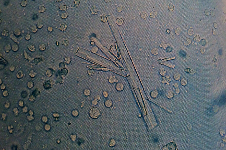 Sulfa crystals, white blood cells and bacteria suggest a urinary tract infection
400X
Source: Urinalysis and Body Fluids: Strasinger, Susan K.