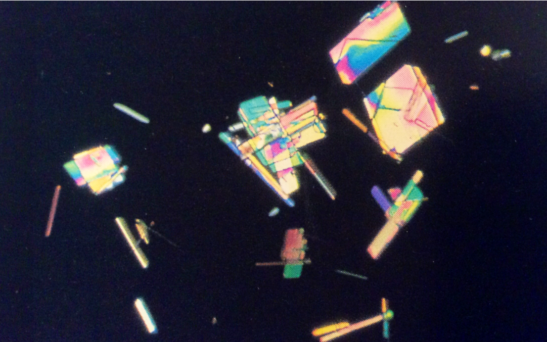 Cholesterol crystals, polarized
400X
Source: Urinalysis and Body Fluids: Strasinger, Susan K.