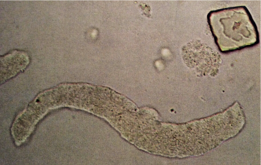 Finely granular cast in urine. Also, note uric acid crystal
160X
Source: Urinary Sediment: A Textbook Atlas. Haber, Meryl H.