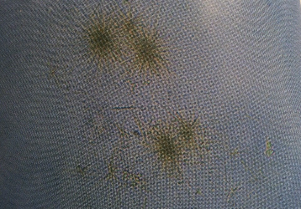 Tyrosine crystals
Yellow color suggests liver disease
400X
Source: Urinalysis and Body Fluids: Strasinger, Susan K.