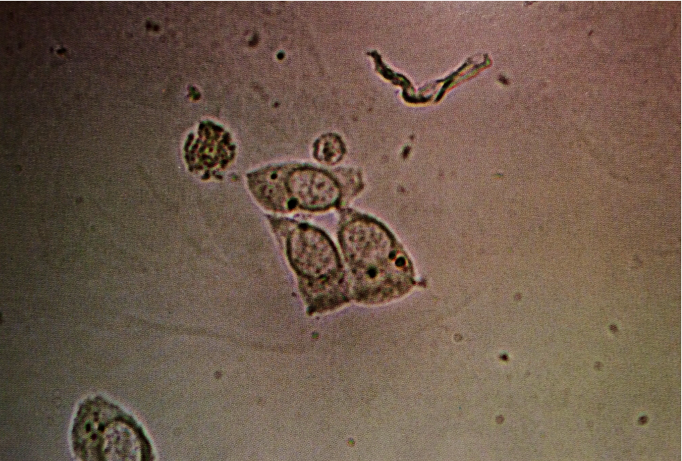 Three renal epithelial cells, whose nuclei are approximately the same size as an adjacent neutrophil. Renal epithelial cells are polyhedral and columnar. Their nuclei are often slightly off center and displaced towards the cell base. A microvillus...