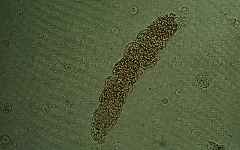 Granular cast revealing certain cellular parts. Note numerous red cells and occasional white blood cells in the background
160X
Source: Urinary Sediment: A Textbook Atlas. Haber, Meryl H.