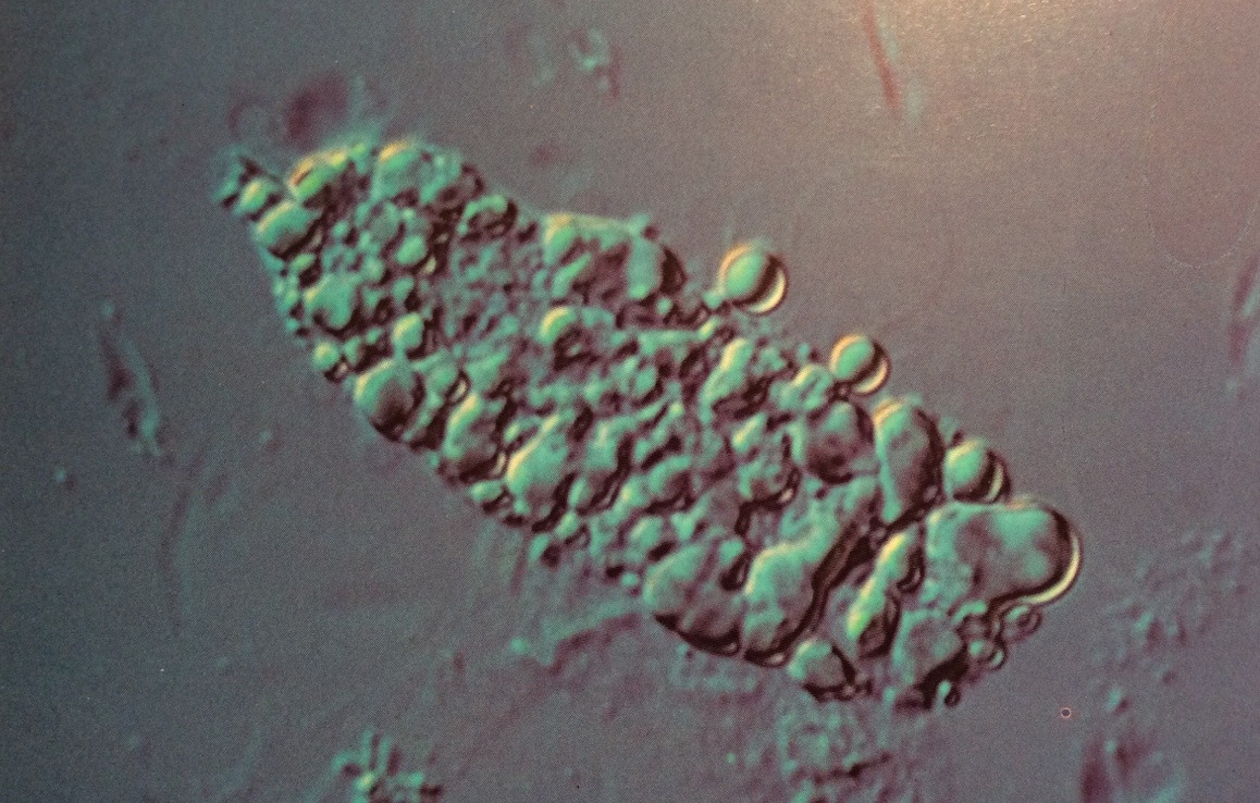 Fatty cast. Lipid globules are prominent on its surface, but some uninvolved surface areas can also be seen underlying the lipids. Some lipid globules are also adjacent to the cast
Interference-contrast microscopy, 400X
Source: Urinary Sediment: A...