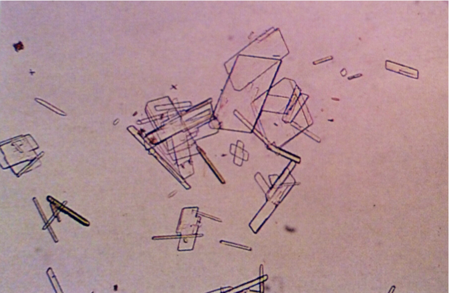 Cholesterol crystals
Notice notched corners
400X
Source: Urinalysis and Body Fluids: Strasinger, Susan K.