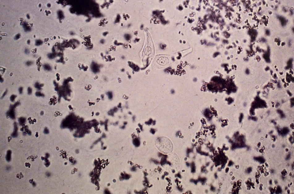 Four transitional epithelial cells (center). Although there is much amorphous crystalline material in the field, the cells are still easily recognized. Two are “tadpole”-shaped, whereas the other two are spheric
160X
Source: Urinary Sediment: A...