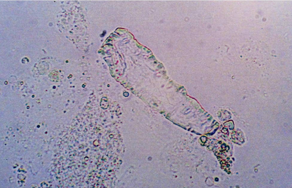 Artifact resembling a waxy cast
Notice lack of typical cast form and refractility
400X
Source: Urinalysis and Body Fluids: Strasinger, Susan K.