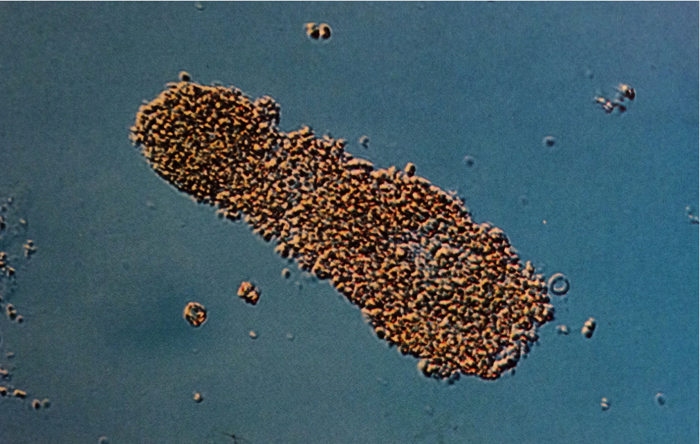 Coarse granular cast, easily seen with interference-contrast microscopy
Interference-contrast microscopy, 160X
Source: Urinary Sediment: A Textbook Atlas. Haber, Meryl H.