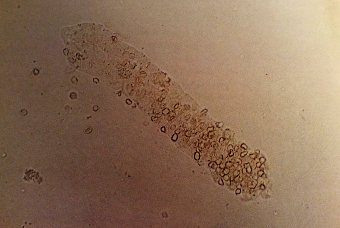 Red blood cell cast. Erythrocytes are more densely concentrated towards one end of hyaline cast matrix
160X
Source: Urinary Sediment: A Textbook Atlas. Haber, Meryl H.