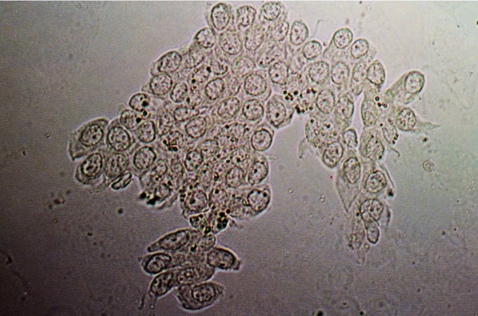 Group of transitional epithelial cells in urine, which are spheric and contain central large nuclei
160X
Source: Urinary Sediment: A Textbook Atlas. Haber, Meryl H.