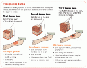 Burn injury degrees lawyer