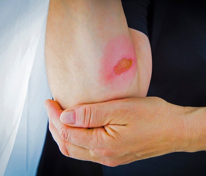 burn injury lawyer