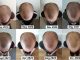 hair growth supplements protocol