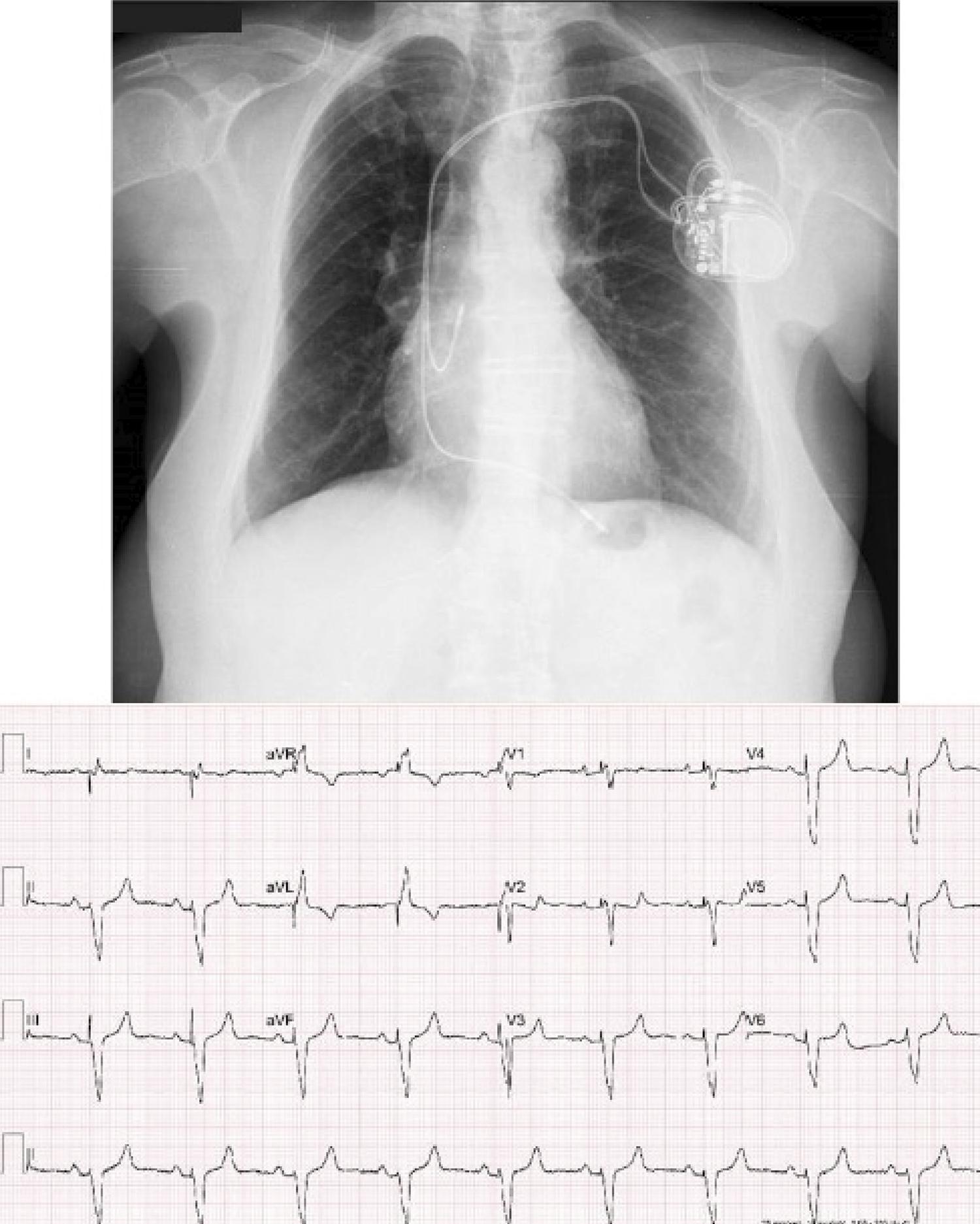 Transposition Of The Great Arteries X Ray