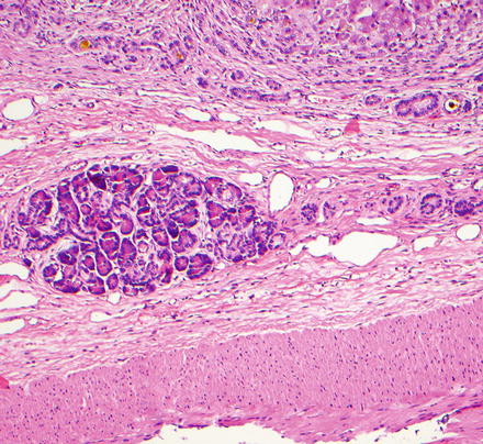 Pseudotumors | Abdominal Key