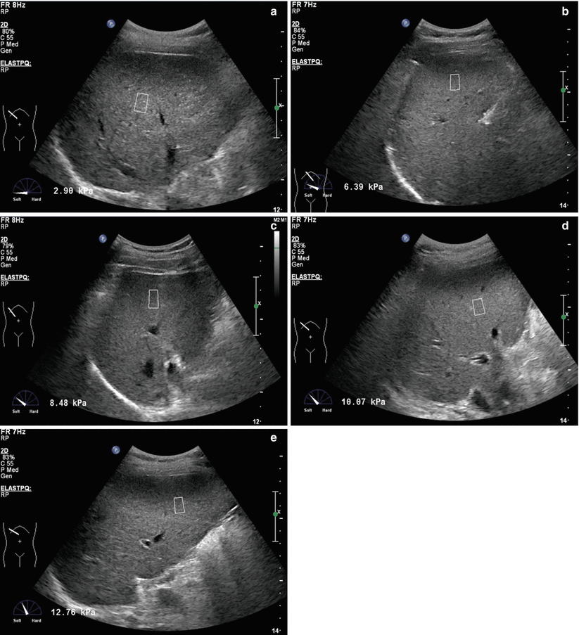 Ultrasound Elastography in the Assessment of Liver Fibrosis | Abdominal Key