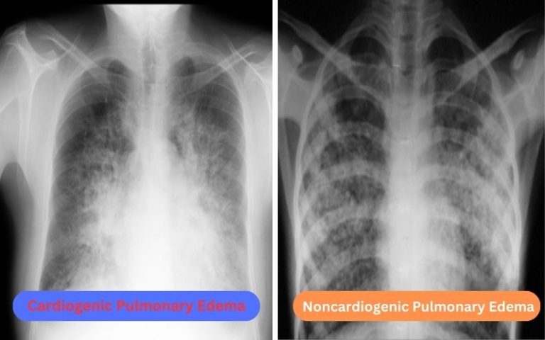 Cardiogenic and Noncardiogenic Pulmonary Edema - Best 11 Difference - A ...