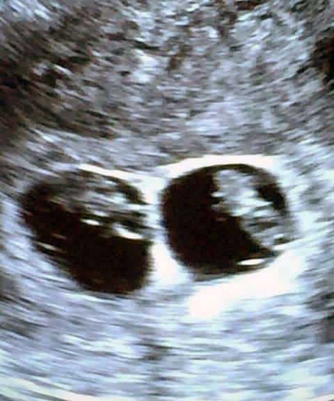 9 Weeks Pregnant With Twins: Ultrasound, Symptoms & Physical Acticity ...