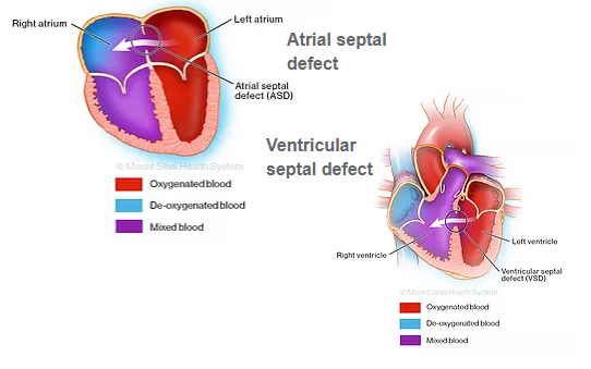 Congenital Heart Surgery - Adelaide Cardiothoracic