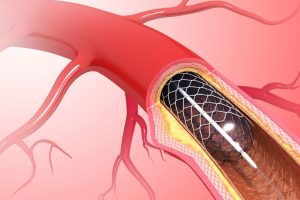 Angioplasty Procedure