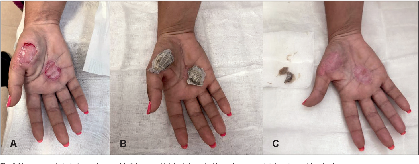 Figure 5 from Coberturas transitorias en quemaduras | Semantic Scholar image.