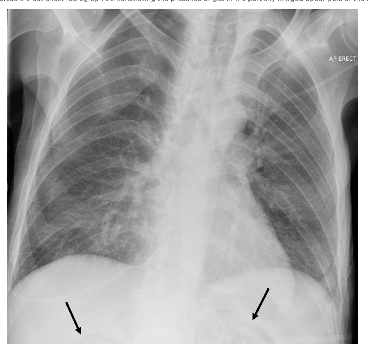 Figure 1 from Severe emphysematous pyelonephritis as a complication of ...