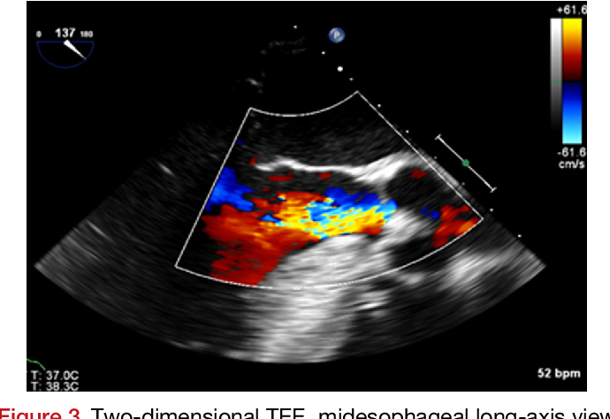 Figure 3 from Functionally Bicuspid Quadricuspid Aortic Valve ...