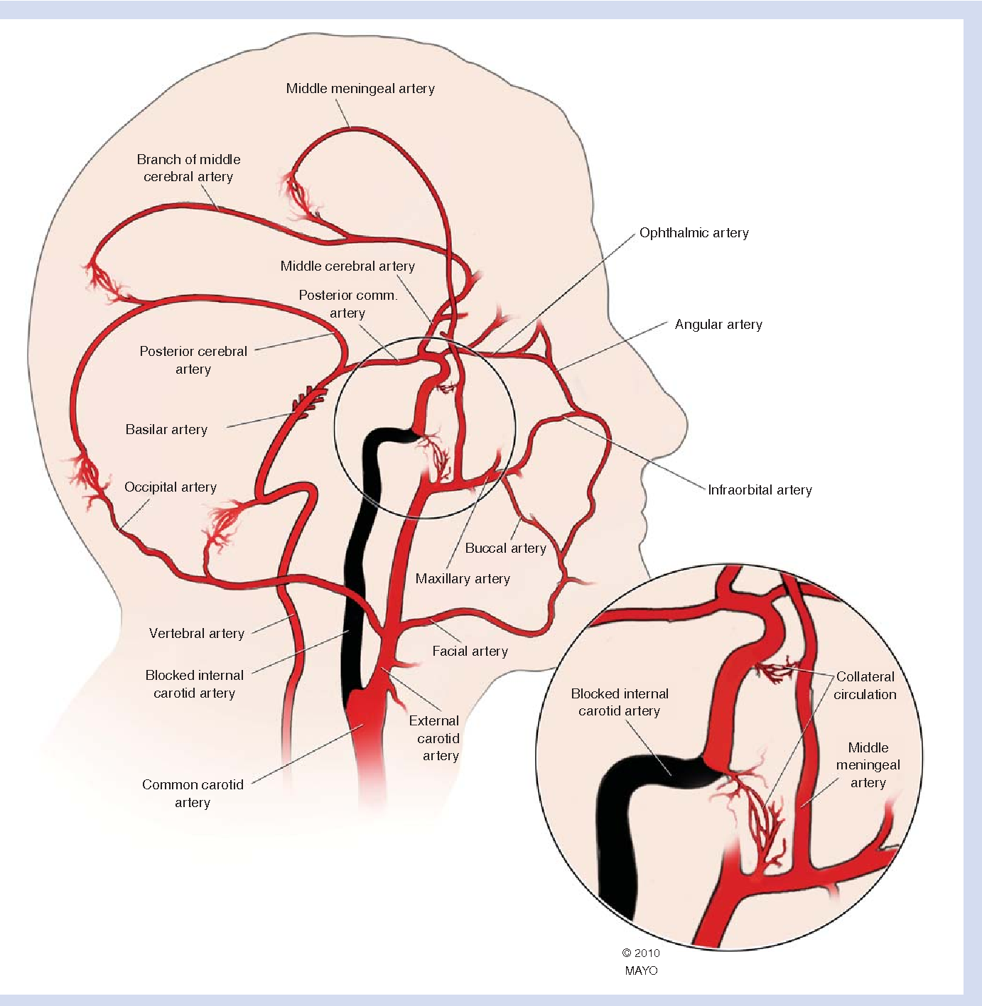 Figure 2 from Carotid artery disease: stenting vs endarterectomy ...