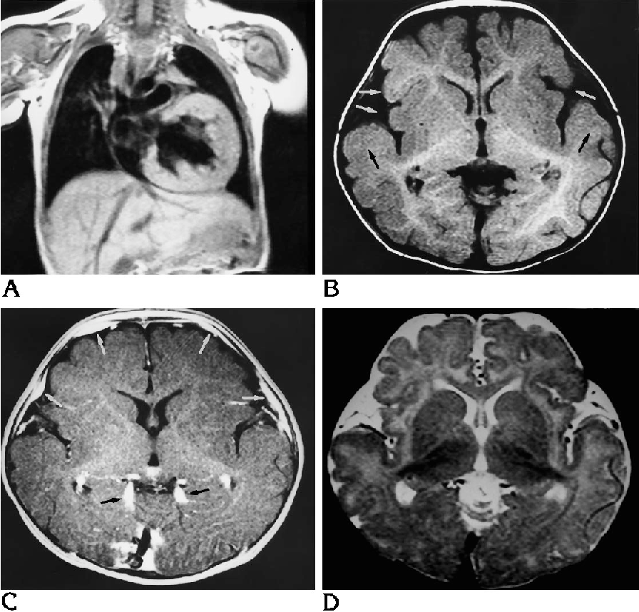 Figure 1 from Cerebral MR manifestations of Pompe disease in an infant ...