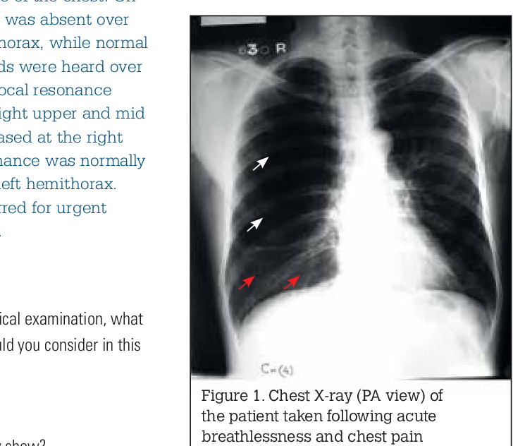 Figure 1 from Acute breathlessness--a case study of a chronic smoker ...