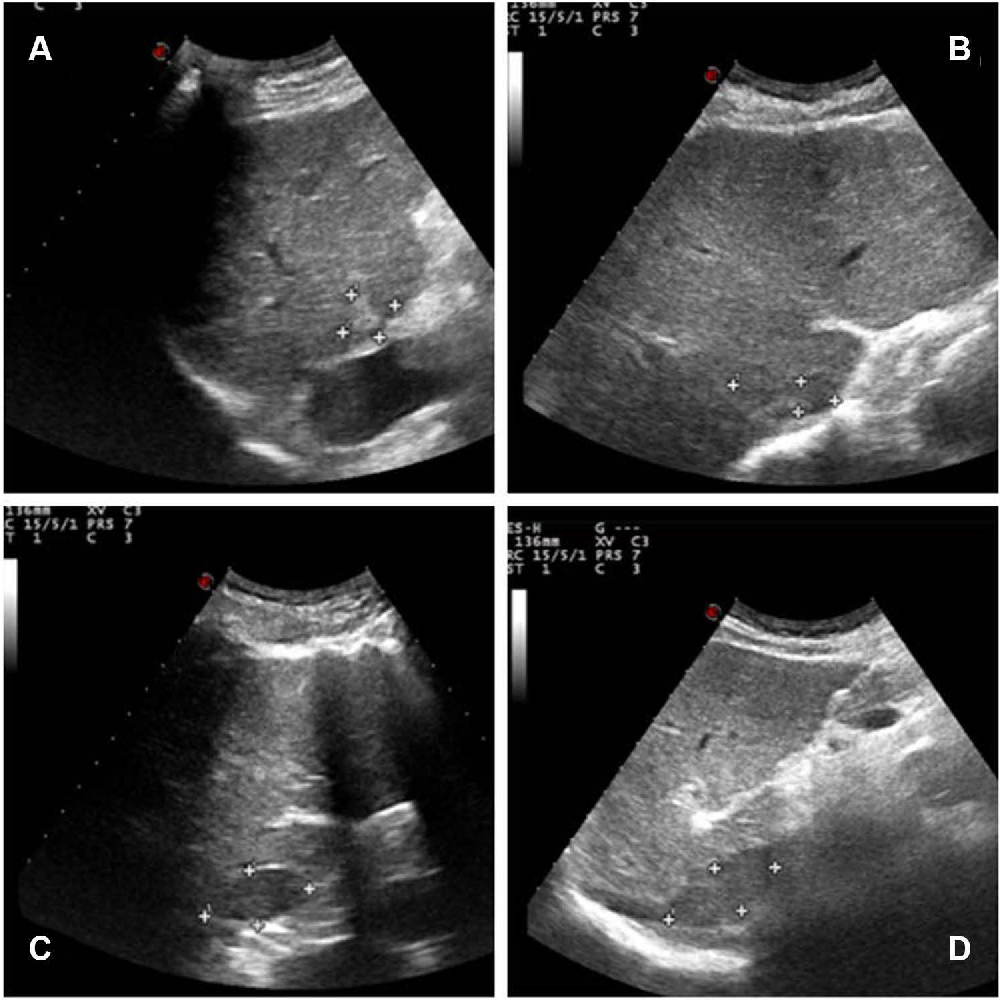 Figure 1 from Complete Response of Hepatocellular Carcinoma with ...