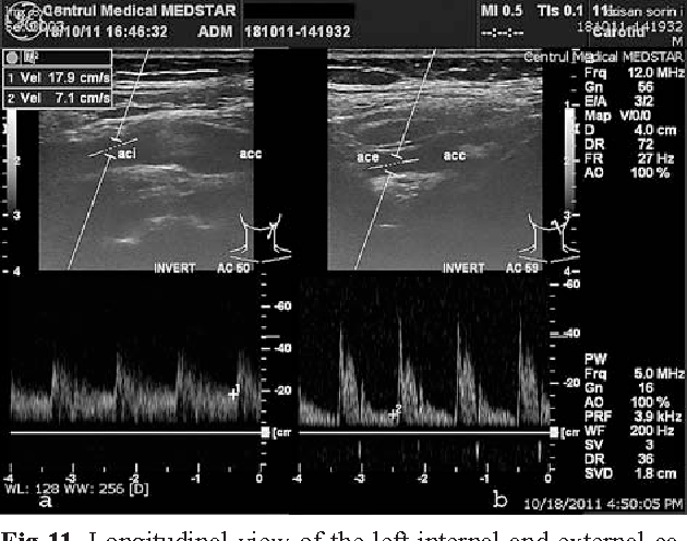 Carotid Ultrasound Waveforms