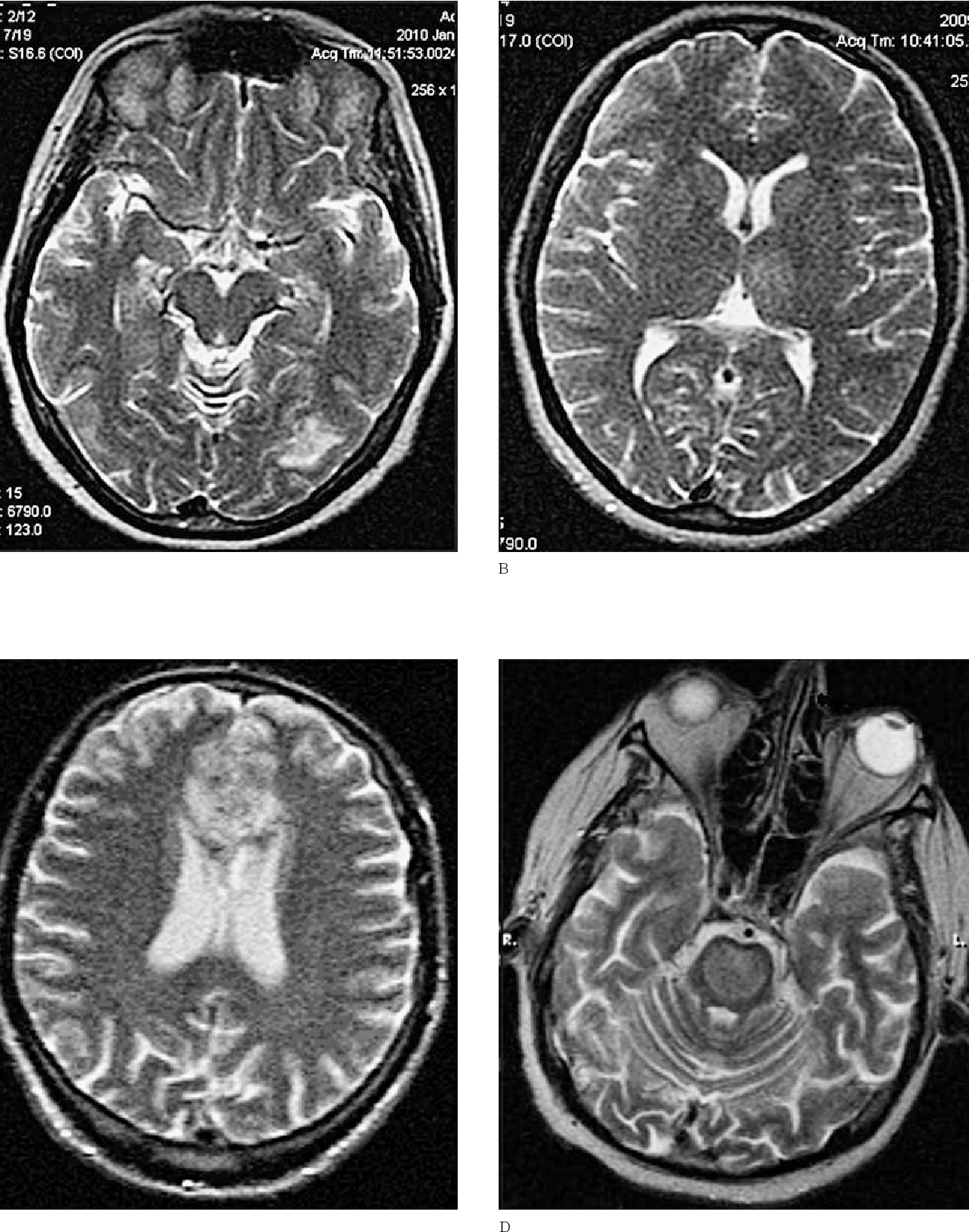 Figure 1 from How to Distinguish between Venous and Arterial Strokes ... image.