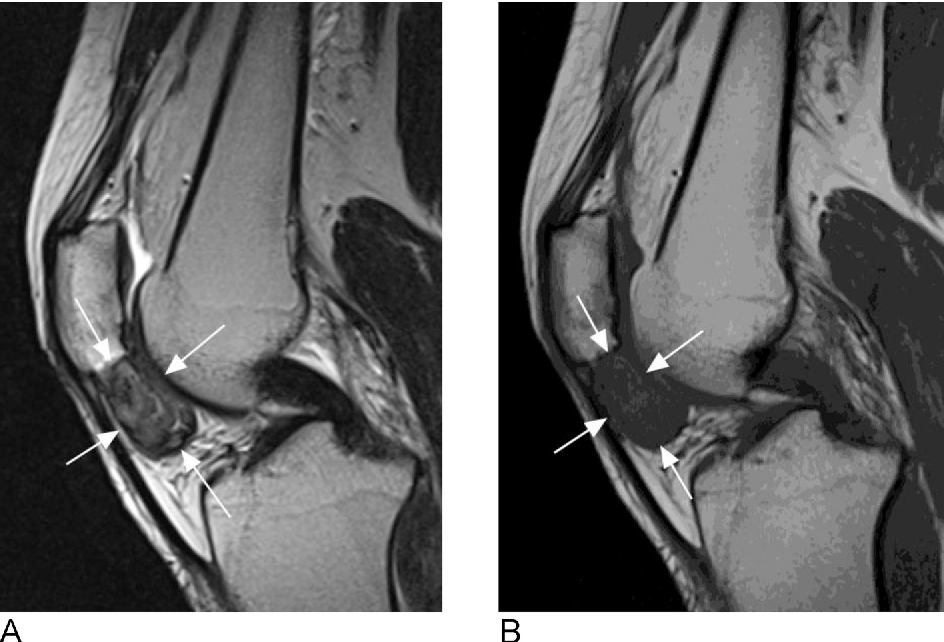 MRI Fat Pad Impingement Knee